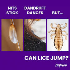 Image result for lice vs dandruff