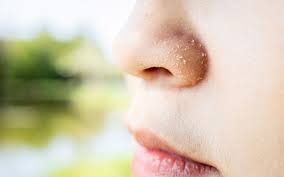 Dry Skin Around The Nose 8 Causes 9 Treatments Important Preventio Skinkraft