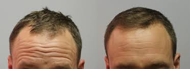 Hair Transplant In Mumbai In 2020 Hair Transplant Hair Transplant Cost Body Hair Transplant