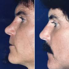 Revision Rhinoplasty