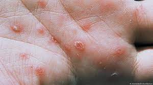 A blotchy red rash on the. Syphilis Das Chamaleon Der Medizin Wissen Umwelt Dw 16 07 2012