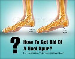 How To Get Rid Of A Heel Spur?