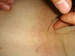 Breast cancer is the second most common cancer found in women — after skin cancer — but that doesn't mean men aren't at risk as well. Acupuncture Reduces Radiation Induced Dry Mouth For Cancer Patients Imaging Technology News