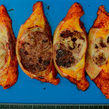 One type of breast cancer, inflammatory breast cancer, does not usually cause a lump but instead in contrast to breast cancer tumors, benign lumps are often squishy or feel like a soft rubber ball with when looking at mammogram pictures, cancers often appear bright and the area around the. Macroscopic Findings Of The Resected Left Breast Tumor The Mass Was Download Scientific Diagram