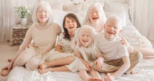Küçüklüğümden beri albino birini gördüğümde içim hep bir tuhaf olur. Life With Four Children With Albinism Has Been Quite The Adventure Family Adopts 4 Albino Children Whose Unique Rare Condition Makes Our Hearts Full Love What Matters