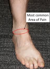 Pin On Ankle Pain Remedies