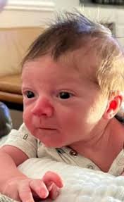 Hemangioma, port wine stain , stork bite? Any momma's dealing with this?