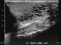 It typically occurs in those with a prior vasectomy but can be also seen with other causes of obstruction of the ductus deferens. Tubular Ectasia Of Rete Testis Radiology Case Radiopaedia Org