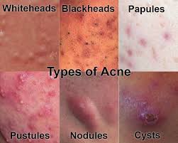 Reviewed and updated by dr amanda oakley dermatologist, hamilton, new zealand; Types Of Acne With Pictures Mild Moderate Severe Ehealthstar