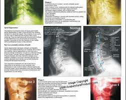 Dermatomes Myotomes And Dtr Poster 18 X 24 Chiropractic Etsy Color Therapy Healing Chiropractic Human Muscle Anatomy