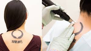 If you need a tattoo removed and don't want pain or mess, tattoo removal without lasers is your best bet. 11 Things No One Tells You About Tattoo Removal Glamour