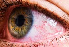 Eye Health What Your Eye Symptoms May Mean