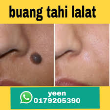 Tahi lalat yang terletak tepat di kelopak mata melambangkan ketidakharmonisan dalam keluarga sedangkan tahi lalat di bawah mata adalah pertanda bahwa kamu adalah orang yang emosional. Free Buang Tahi Lalat Wasap Admin Yeen Www Wasap My 60179205390 Www Wasap My 60179205390 Www Wasap My 60179205390 Berminat Boleh Instagram Rasa Saya