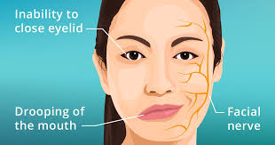 Eating bananas regularly might help you get rid of twitching as soon as possible. Bell S Palsy Eyelid Or Eye Twitching Causes Symptoms Treatment