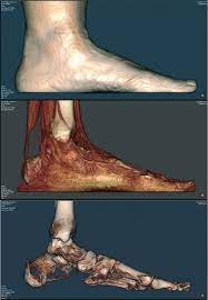 Check spelling or type a new query. Saying Pttd Is Misleading It S Time For A New Lexicon To Distinguish Pathologies Lower Extremity Review Magazine
