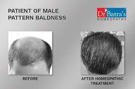 Suitable for all hair types. Dr Batra Hair Loss Treatment Reviewmouthshut