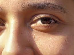 It involves cutting the milium cyst (one milia) open with a sterile needle or knife and removing the cyst with an extraction tool. Milia Causes Treatments And Removal Of Tiny White Facial Bumps Allure