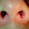 Este paciente presentó un caso de una infección micótica periorbitaria conocida como mucormicosis o ficomicosis. Https Encrypted Tbn0 Gstatic Com Images Q Tbn And9gcsumj1rpgh7hq5rfbjro8oysfaq6trdit4upgddzigw7rherrvb Usqp Cau