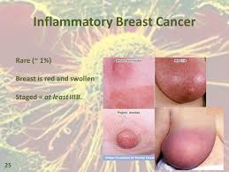Your doctor will use staging information to plan the most effective breast cancer treatment for you. Breast Cancer 1 Leukemia Lymphoma New Diagnoses Each Year In The Us 112 610 Adults 5 720 Children 43 340 Died Of Leukemia Or Lymphoma In Ppt Download