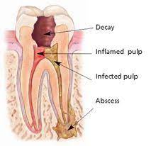 Root Canals Can Save Teeth Root Canal Treatment Root Canal Dental Decay