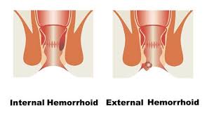 Shrinking hemorrhoids by physically forcing the blood out. About Hemorrhoids Orange County Hemorrhoid Clinic