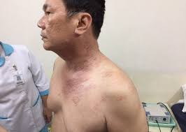 LAPORAN KASUS HERPES ZOSTER