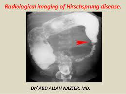 Presentation1 Radiological Imaging Of Hirshsprung Disease