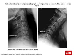 Please understand that our phone lines must be clear for urg. Extension Lateral Cervical Spine Radiograph Showing Normal Alignment Of The Upper Cervical Spine Extension Lateral Cervical Spine Radiograph Showing Ppt Download