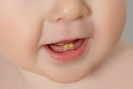 What Causes Discoloration Of Baby Teeth