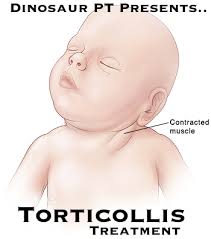 Torticollis Treatment for Children