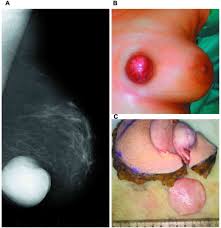 Image result for Dermatofibrosarcoma Protuberans