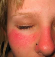 Image result for Sunburn