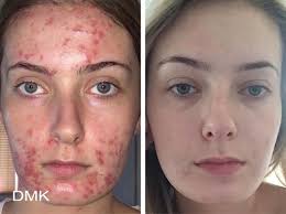 The mask contains living enzymes that stimulate our own natural. Dmk Enzyme Therapy Kay Co Cosmetic Rejuvenation