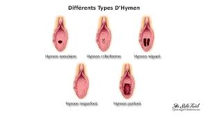 Les différents types d'hymen - Hyménoplastie Et Chirurgie Intime ...