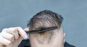 Du hast generell dünnes haar und vielleicht auch schon lichtes haar am oberkopf oder geheimratsecken? Was Du Gegen Den Haarausfall Nach Der Chemotherapie Tun Kannst