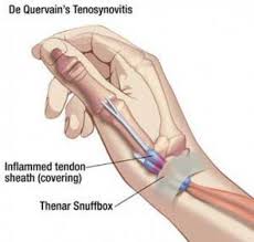 The image below shows the bones of the hand from the back side. Tendon Conditions Merivale Hand Clinic