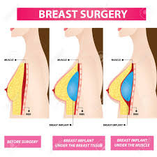 Plastic Surgery Of Breast Implant Before And After Vector Illustration