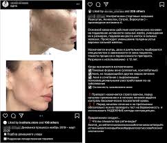 Акне (acne vulgaris) — хроническое воспалительное заболевание достижение суммарной дозы способствует длительной ремиссии акне средней и тяжелой степени 4. Akne U Vzroslyh Skolko Stoit Lechenie Prichiny Vysypanij Preparaty I Sredstva Dieta