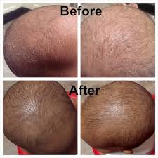 The condition is characterized by a flaky and reddened scalp, making it look like your little one has dandruff. How To Treat Eczema On Baby Head