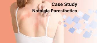Image result for Notalgia Paresthetica