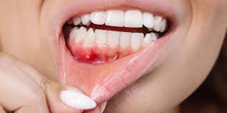 Image result for dental cancer
