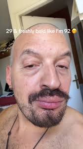 Lower Blepharoplasty Experience at 29 Years Old