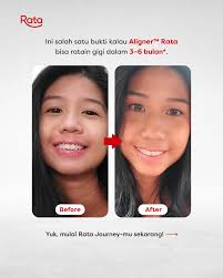 Hi Sobat Ola! 🦷 Behel Gigi, ada apa aja jenisnya? Nggak semua behel itu  sama, lho! Pemilihan jenis behel biasanya disesuaikan dengan kebutuhan,  kenyamanan, dan juga faktor estetik. ✨ 🔹 Behel Metal