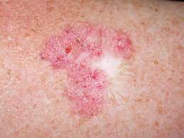 Normal moles don't typically turn into melanoma with 70% of. Managing Non Melanoma Skin Cancer In Primary Care A Focus On Topical Treatments Bpj 57 December 2013