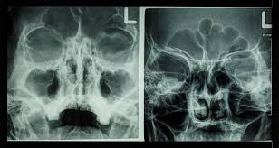 Image result for Sinus X Ray