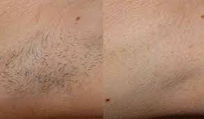 When you have your laser session only around 15% of your hairs will be in this phase. Bellair Laser Clinic Laser Hair Removal Faqs