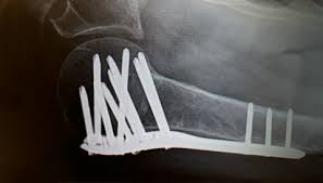 Brudd i øvre del av overarmen utgjør cirka 5 prosent av alle brudd. Skal Finne Den Beste Behandlingen Av Kompliserte Skulderbrudd