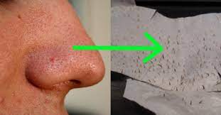 Maske aus gelatine und aktivkohle ist geeignet für menschen jeden alters aufgrund ihrer sicherheit und effektivität. Mit Diesen 2 Einfachen Zutaten Gegen Hautprobleme Kampfen Geniale Tricks