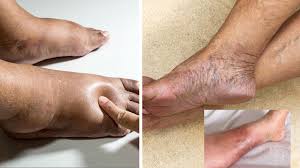 Image result for liver spots on legs