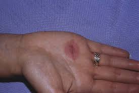 Image result for Fixed Drug Eruption